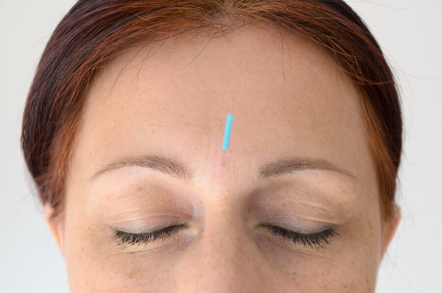 Acupuncture for Hot Flashes Is a Total Game-Changer